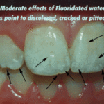 dental-fluorosis.gif